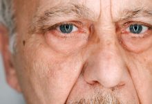 Glaucoma pseudoesfoliativo